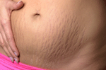 Stretch Marks Pregnancy